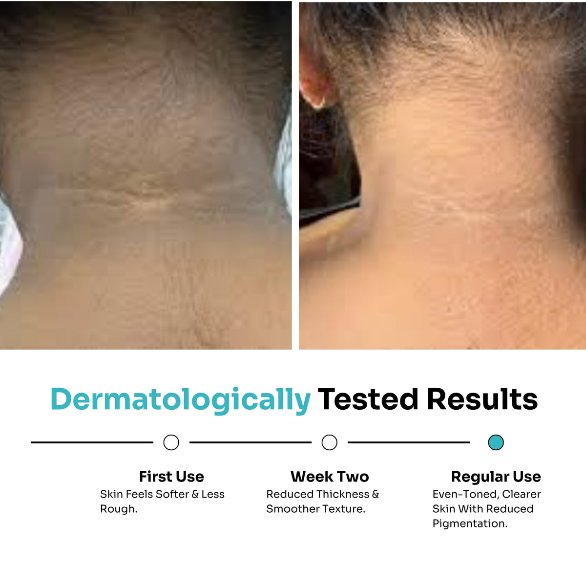 Nigriclear™ Cream for Pigmentation & Acanthosis Nigricans (50gm)