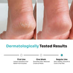 Kitcoz Foot Cream Roll On with 20% Urea, 2% Lactic Acid, Glycerine & Olive Oil for Dry Feet, Cracked