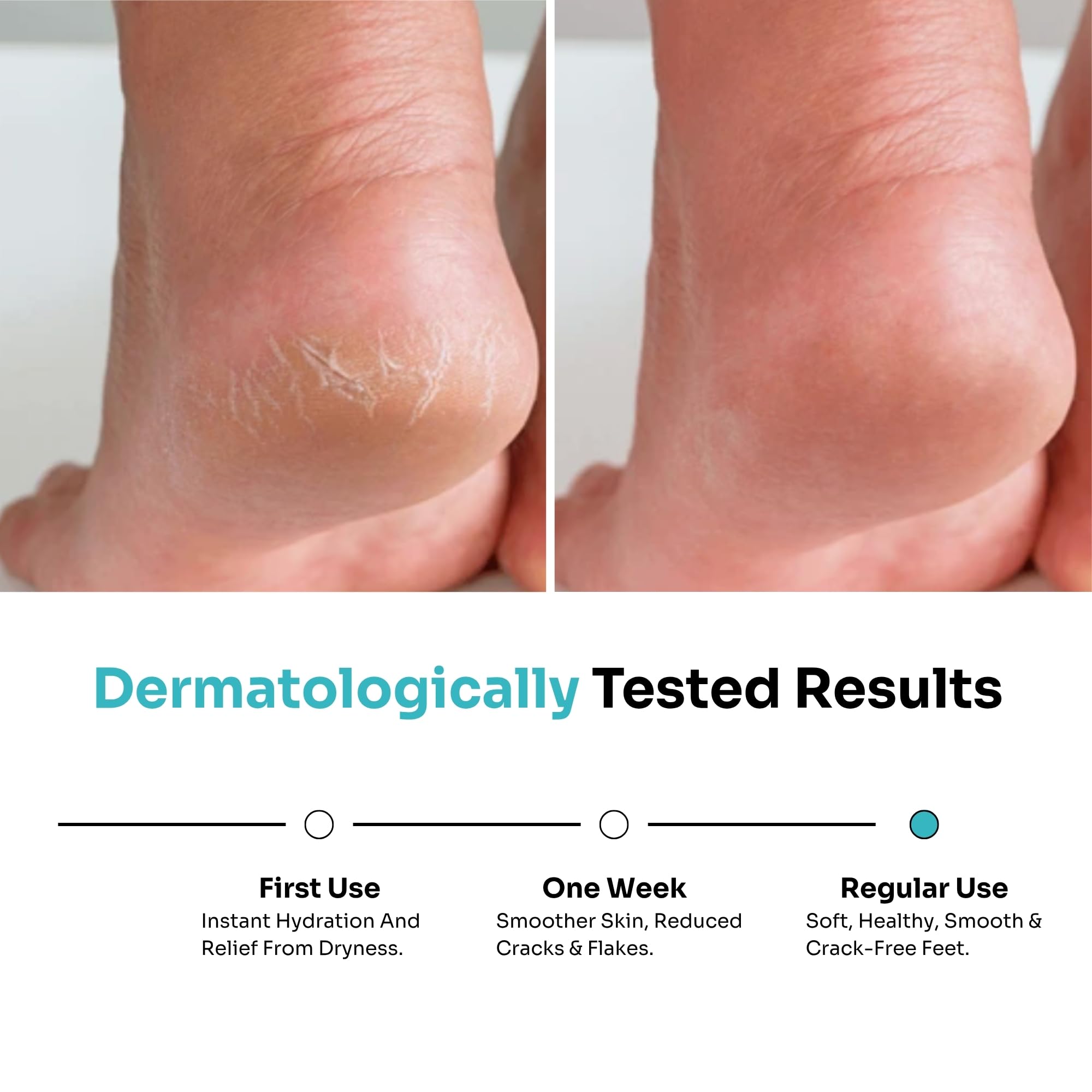 Kitcoz Foot Cream Roll On with 20% Urea, 2% Lactic Acid, Glycerine & Olive Oil for Dry Feet, Cracked